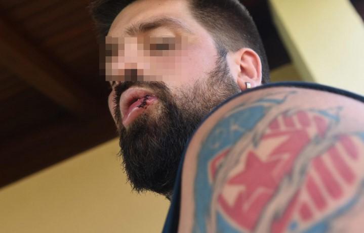 Srbin iz Austrije pretučen u Baškoj Vodi zbog tetovaža
