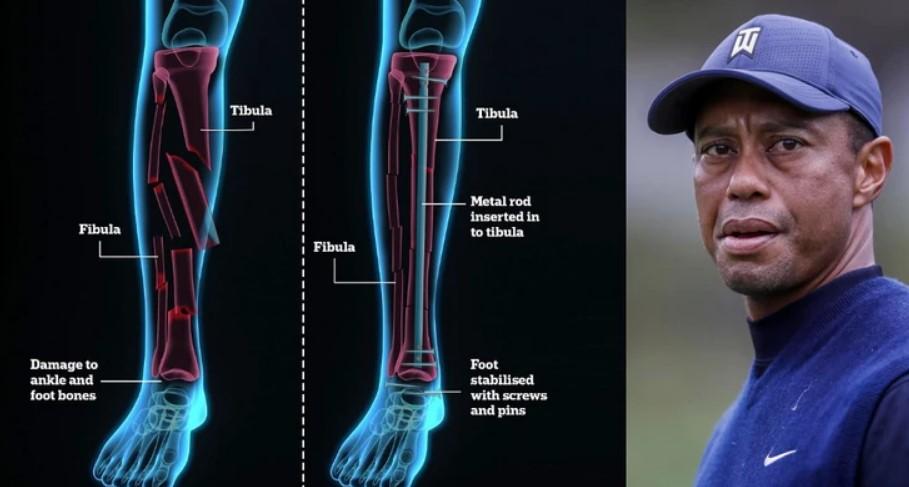 Prikaz noge Tajgera Vudsa sve govori, hirurg ne može tvrditi da će opet moći igrati golf