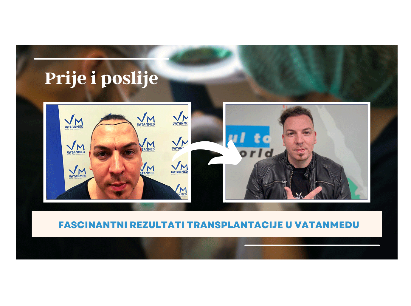 Prvi rezultati uspješne transplantacije vidljivi su već nakon mjesec dana - Avaz