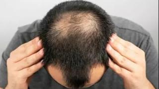 Otkrivena veza između testosterona i gubitka kose kod muškaraca